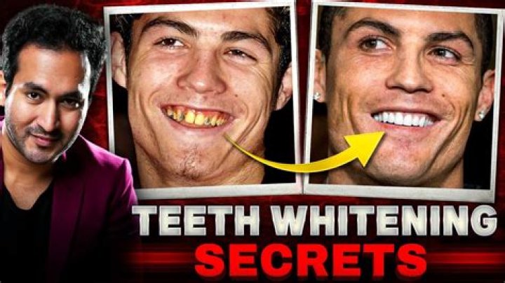Why Is Idris Elba Teeth So White? Fans Suspect Dental Surgery Or Fake Tooth